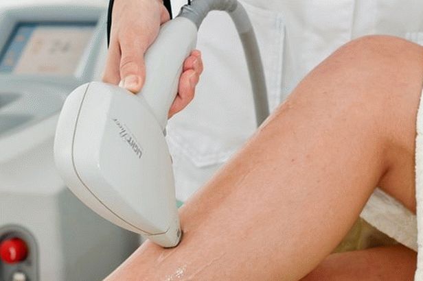 diode laser hair removal