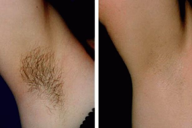 diode laser hair removal