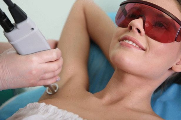 How to prepare for laser hair removal