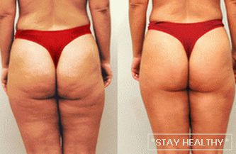 Mesotherapy for weight loss