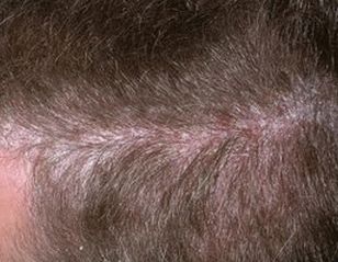 psoriasis disease of the scalp and scalp, photo of the initial stage