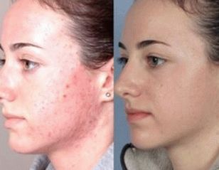 photo of facial skin after treatment of psoriasis