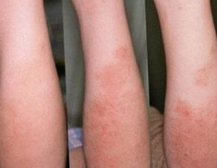 How is the initial stage of psoriasis in children photo?