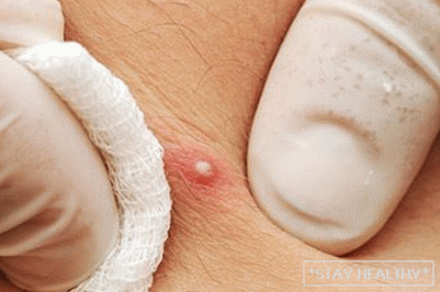 Papules on the skin of the face and body: types, sizes andways of deliverance
