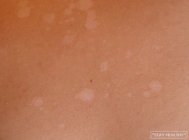 White spots on the skin after sunburn, фото
