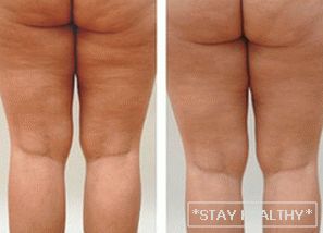 The whole truth about cellulite